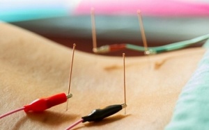 Châm cứu có giúp làm giảm táo bón chức năng mạn tính?