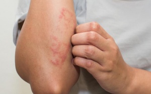 Tắm bằng muối biển và thuốc tím giúp giảm eczema
