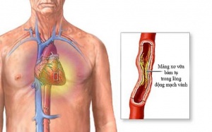 Hẹp mạch vành khi nào cần phẫu thuật?