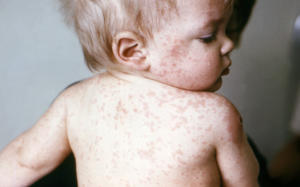 Sốt cao, nổi ban, ho nhiều, bệnh nhi nhập viện vì biến chứng bệnh sởi