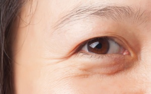 Làm thế nào để làm mờ nếp nhăn dưới mắt, quanh mắt?