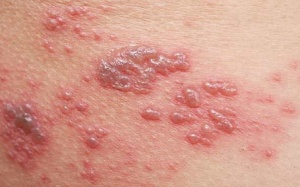 Làm gì để ngăn ngừa bệnh zona tái phát?