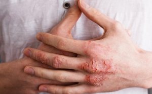 Làm thế nào để tránh eczema bùng phát nếu không có thuốc steroid?