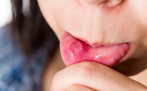 Vì sao bạn thường xuyên bị nhiệt miệng khi Hè về?