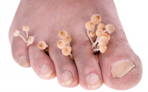 Nguyên nhân nào gây nấm bàn chân?