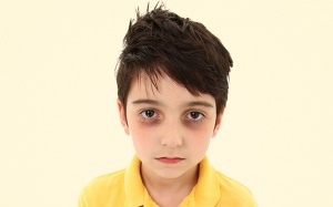 Trẻ nhỏ bị thâm quầng dưới mắt do đâu?