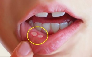 Phân biệt nhiệt miệng và tổn thương khoang miệng