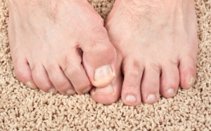 Triệu chứng cảnh báo bạn đang bị nấm bàn chân 