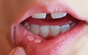 Xử lý nhiệt miệng bằng thảo dược