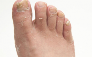 Nấm da chân nguy hiểm như thế nào?