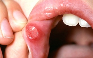 9 bài thuốc Đông y giúp trị nhiệt miệng hiệu quả