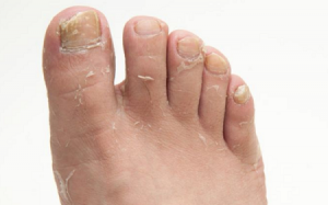 Bài thuốc dân gian trị nấm bàn chân