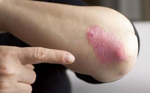 Sự khác biệt giữa bệnh vẩy nến và eczema là gì?
