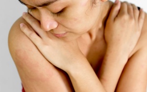 Khắc phục dị ứng da bằng các biện pháp tự nhiên