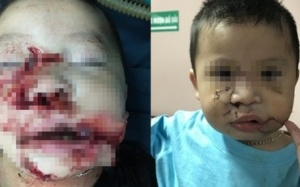 Bé trai 2 tuổi bị chó cắn nát mặt được tạo hình thành công