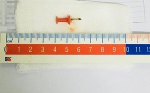 Bé gái 12 tuổi suýt mất mạng vì nuốt phải ghim sắt