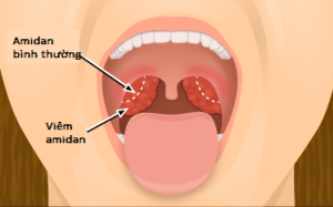 Trẻ bị viêm amidan: Điều trị và phòng ngừa cách nào hiệu quả?