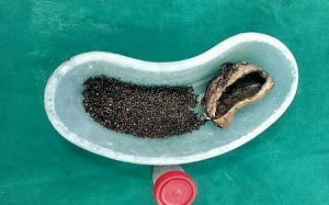 Phẫu thuật loại bỏ hơn 4.100 viên sỏi mật trong bụng