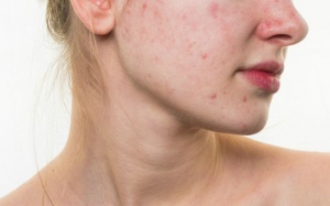 Bị mọc nhiều mụn trứng cá: Nên ăn gì và không nên ăn gì?