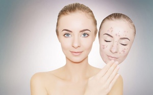 Những cách đơn giản giúp loại bỏ khuyết điểm trên da