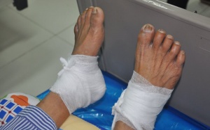 Cảnh báo: Bỏng chân do đắp hỗn hợp lá ngải cứu trị đái tháo đường