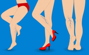 8 cách tự nhiên giúp cải thiện suy giãn tĩnh mạch