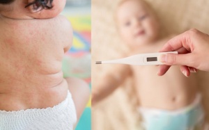 Sốt phát ban và sởi ở trẻ em khác nhau thế nào? 