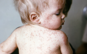 Triệu chứng bệnh sởi ở trẻ: Đừng nhầm với cảm lạnh hay sốt phát ban!