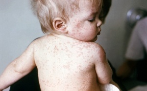 Phòng ngừa bệnh sởi ở trẻ thế nào?