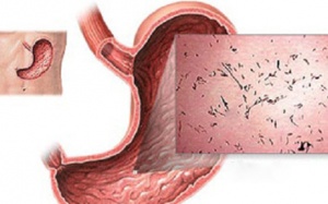 Biến chứng nguy hiểm của viêm dạ dày ruột do vi khuẩn 