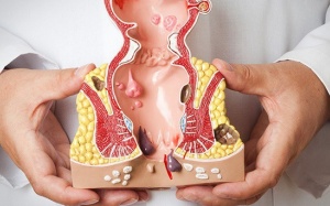 Ung thư hậu môn: Những triệu chứng cần cảnh giác