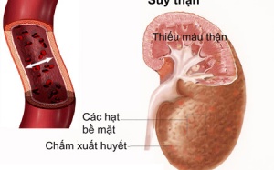 Bệnh đái tháo đường gây biến chứng suy thận điều trị ra sao?