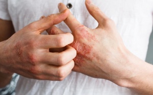 7 cách đơn giản giúp phòng ngừa eczema