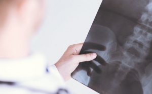 Nguyên nhân nào dẫn đến tình trạng lệch đốt sống?