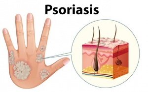 Nhận diện các loại vẩy nến thường gặp theo cách đơn giản nhất