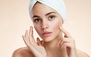 Cách điều trị mụn trứng cá nặng không để lại sẹo