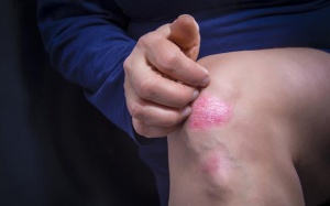 Hiểu về vẩy nến theo cách đơn giản nhất