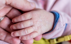 Vì sao trẻ sơ sinh bị da khô, bong tróc?