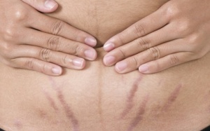 Làm sao để xóa mờ vết rạn da?