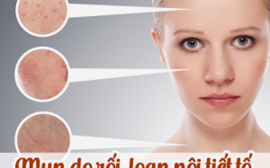 10 điều cần biết về mụn nội tiết