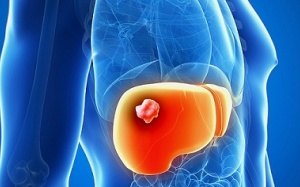 Tỷ lệ tử vong do ung thư gan ở Mỹ đã tăng 43% sau 16 năm