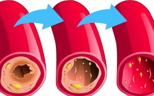 5 thực phẩm giúp làm sạch động mạch, ngăn ngừa đột quỵ, đau tim