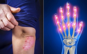 Có thể bị viêm khớp vẩy nến và viêm khớp dạng thấp cùng lúc hay không?