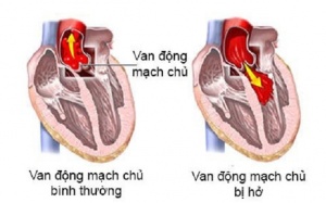 Hở van động mạch chủ 2/4 có nguy hiểm không?