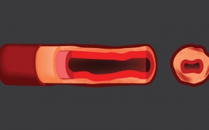 Các loại viêm mạch thường gặp