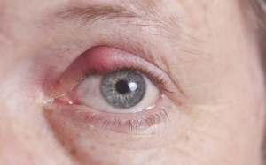 8 cách điều trị lẹo mắt hiệu quả tại nhà