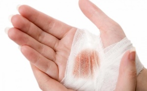 Dùng Subạc có giúp ngừa vết thương nhiễm trùng?