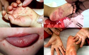 Những điều cần biết về bệnh tay chân miệng