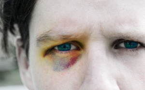 Màu sắc của vết bầm: Từ đỏ chuyển sang xanh, tím có bất thường?