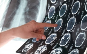 7 mẹo đơn giản giúp phòng ngừa đột quỵ